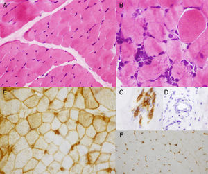 Biopsia muscular con tinción de hematoxilina-eosina con fibras musculares sin variabilidad en el tamaño de las fibras (A) y agregados de células linfohistiocitarias focales (B), que expresan marcadores inmunohistoquímicos para linfocitos maduros (C); sin evidencia de vasculitis (D). Expresión inmunohistoquímica para el complejo mayor de histocompatiblidad tipo i (HLA) en el sarcolema de la práctica totalidad de las fibras y ocasionalmente del sarcoplasma (E). Tejido muscular control (F).