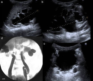 a y b) Ureterohidronefrosis grado iv bilateral. c) Vejiga trabeculada con divertículos. Dilatación ureteral. d) Pielografía retrógrada que muestra ureterohidronefrosis bilateral.