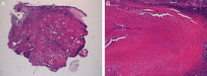 A) Tumoración sólida bien delimitada, formada por una zona periférica con células basaloides y una parte central con células eosinófilas. B) Células con citoplasma eosinófilo y pérdida del núcleo (células fantasma) junto con células transicionales.