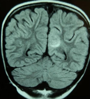 FLAIR T2; imagen coronal. Foco hiperintenso en la sustancia blanca subcortical occipital izquierda, compatible con edema, en la paciente 2.