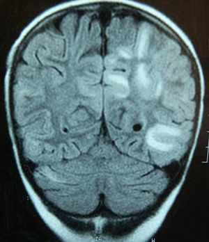 FLAIR T2; imagen coronal. Áreas hiperintensas de afectación subcortical parietooccipital izquierda y en el hemisferio cerebeloso derecho en la paciente 3.