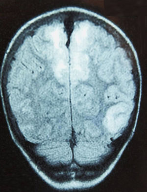 FLAIR T2; imagen coronal. Lesiones hiperintensas córtico-subcorticales parietales bilaterales y occipital izquierda, en relación con edema en el paciente 4.
