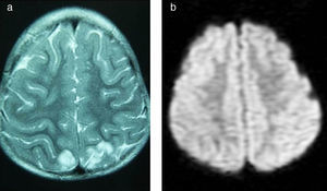 a). FSE T2, imagen axial. Áreas hiperintensas occipitales cortico-subcorticales sugestivas de edema en la paciente 5. b). DIFUSIÓN, imagen axial. Ausencia de restricción a la difusión en regiones cortico-subcorticales occipitales, indicativo de edema vasogénico en la paciente 5.