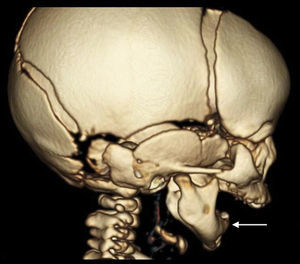 Reconstrucción tridimensional por tomografía computarizada del paciente del caso número 2 previo a la distracción mandibular. Se observa el tamaño más pequeño de la mandíbula y su posisción más posterior (flecha blanca) con respecto al maxilar superior como hallazgos compatibles con microrretrognatia.