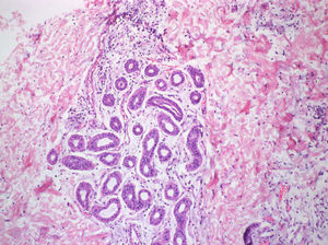 Imagen compatible con dermatosis neutrofílica histiocitoide observándose grupos de linfocitos, histiocitos y células mononucleares.
