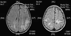 Caso 16. Imágenes RM, secuencia FLAIR: zonas de hiperintensidad en la sustancia blanca profunda subcortical en regiones occipitales de predominio izquierdo. En algunas lesiones la afectación se extiende a sustancia gris cortical (flechas).