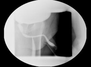 Imagen de la cistografía miccional en la que se aprecia estenosis del meato uretral, con dilatación de la uretra hasta su porción proximal.