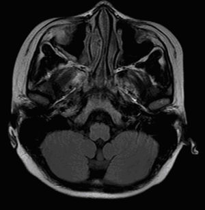 Resonancia magnética craneal: ocupación de celdillas etmoidales predominantemente derechas; engrosamiento mucoso maxilar bilateral.