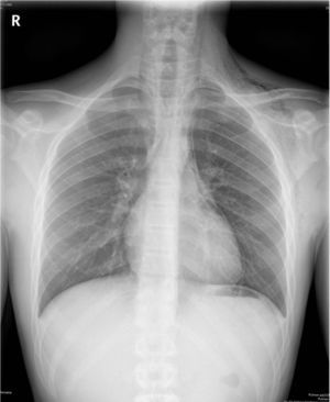 Radiografía de tórax realizada al diagnóstico. Se observan neumomediastino y enfisema subcutáneo en las regiones cervical, supraclavicular y axilar izquierdas.