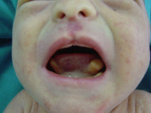Fenotipo oro-facial de la paciente: hamartomas sublinguales en ambos lados + fisura en la línea media del labio superior.