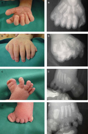 Fenotipo digital clínico y radiológico (Rx) de la paciente. a) Mano derecha con polidactilia central con 6 dedos completos; en la Rx se observa 3.° metacarpiano en Y. b) Mano izquierda con polidactilia central: se observa en la Rx 4.° metacarpiano en Y + polidactilia postaxial con 7.° dedo hipoplásico. c) Pie derecho con polisindactilia preaxial (hallux bifidus); en la Rx 1.er metatarsiano muy ancho con 2 primeros dedos completos a nivel óseo. d) Pie izquierdo con polisindactilia preaxial superponible clínica y radiológicamente a la presente en el pie derecho + polidactilia postaxial con 5.° metatarsiano ancho, en la Rx + 5.° y 6.° dedos con esqueleto óseo completo.