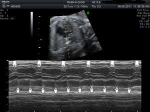 Registro ecocardiográfico en modo M con cursor alineado a través de la pared ventricular y auricular, que demuestra la ausencia de relación entre contracción ventricular y auricular.