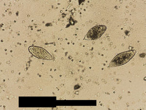 Huevos de Schistosoma haematobium en muestra de orina centrifugada.