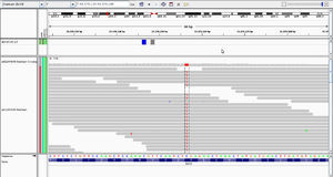 Imagen extraída del estudio de exoma, visualizada en el visor integrado del genoma (IGV, http://www.broadinstitute.org/igv/), en la que se muestra la sustitución detectada (citosina por timina) en todas las lecturas de secuencia y la localización cromosómica de la misma (marca vertical de color rojo en el esquema del cromosoma 7 en la parte superior de la figura.