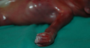En el feto de 22 semanas se observa que los dedos de manos y los pies presentan braquidactilia, pulgares y dedos gordos gruesos. Pulgares con desviación radial. Sindactilia cutánea 2-3-4-5 en los dedos de manos y pies. Palmas cóncavas.
