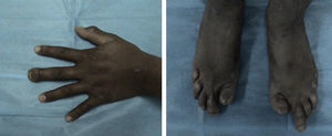Manos y pies del caso índice. Se observa la afección a las porciones distales de los dedos, con uñas distróficas e hipoplásicas.