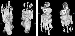 Tomografía con reconstrucción 3D de los pies: muestra la amputación y la destrucción de los componentes óseos de las porciones distales de los ortejos; zonas hipodensas generalizadas indicando osteomielitis en varios puntos del pie.