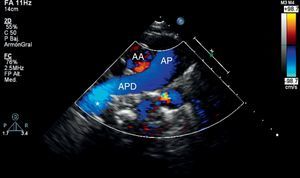 Imagen ecocardiográfica (corte supraesternal doppler-color). Ausencia visual de la arteria pulmonar izquierda; en el extremo distal de la arteria pulmonar derecha se insinúa un bucle de flujo sanguíneo hacia la izquierda (*). AA: arteria aorta, AP: arteria pulmonar; APD: arteria pulmonar derecha.