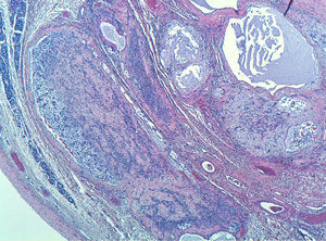 Estudio histológico de tumoración tras tinción con hematoxilina-eosina. Se objetiva ribete de parénquima testicular conservado en la parte izquierda de la imagen. Presencia de áreas de aspecto mixoide con aparición de glándulas. Abundante material de tipo membrana basal en la zona central de la imagen.