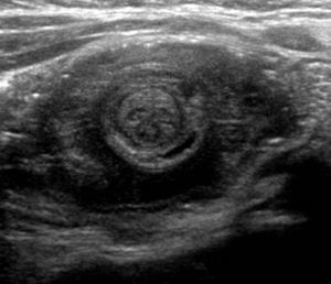 Imagen típica de invaginación intestinal en el estudio de ecografía abdominal.