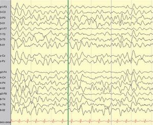 EEG vigilia en lactante de 8 meses: trazado lentificado globalmente con brotes intermitentes de actividad delta.