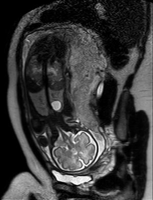 RM fetal en la semana 30 + 4: lesión redondeada bien delimitada en el lóbulo superior del pulmón izquierdo, con señal hiperintensa en esta secuencia SS TSE T2, sin relación con estructuras mediastínicas.