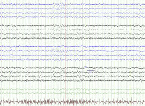 EEG en el momento intercrítico (día 22 del cuadro) que muestra enlentecimiento localizado en hemisferio izquierdo.