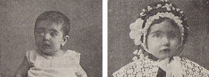 Niña con un sarcoma de ojo, antes y después del tratamiento con radio. Libro de Actas del Primer Congreso Español de Pediatría, p. 315.