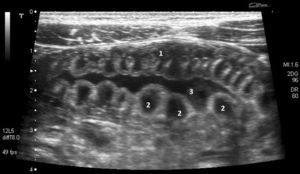 Corte transversal con haz de ultrasonidos en la fosa iliaca izquierda, donde se muestra el engrosamiento de la pared del intestino delgado (1), que consiste en colecciones líquidas anecoicas entre la mucosa y la submucosa (2), con incremento de líquido intraluminal (3).
