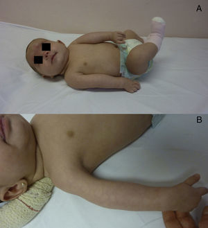 A) Posición típica de extremidades superiores al nacimiento: aproximación y rotación interna de hombros, extensión de codos y flexión palmar de muñecas. B) Disminución de masa muscular en la cara anterior de brazo.