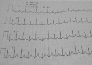 Variaciones clínicas del QRS (alterans eléctrico) debido al movimiento pendular del corazón en el medio líquido, indicativo de taponamiento cardíaco.