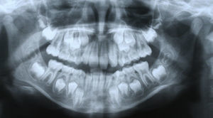 Radiografía panorámica obtenida a los 9años. El incisivo lateral superior derecho es macrodóntico como consecuencia de una fusión dentaria (diente doble). No existen otros supernumerarios.