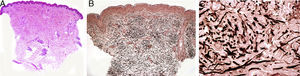 A) Estudio histopatológico con hematoxilina-eosina. Panorámica aparentemente sin lesiones, con discreto aumento de la densidad de la dermis papilar (4×). B) Estudio histopatológico con orceína. Panorámica en la que se objetiva discreto aumento de fibras elásticas (8×). C) Estudio histopatológico con orceína, en el que se observan a mayor detalle las fibras elásticas agrupadas de forma tosca (60×).