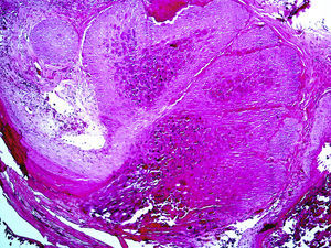 Hiperplasia epitelial con queratinocitos con cuerpos de molusco en su interior (hematoxilina-eosina ×5).