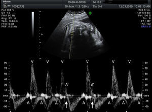 Registro doppler (simultáneo de cava superior y aorta) de extrasístoles bloqueadas (A’). Se puede apreciar cómo A’ se adelanta respecto a la contracción auricular del latido sinusal (A) y no es seguida de contracción ventricular (V).