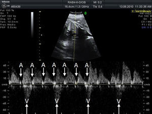 Registro doppler (simultáneo de cava superior y aorta) de bloqueo AV de gradoiii donde las contracciones auriculares (A) y las contracciones ventriculares (V) son independientes.