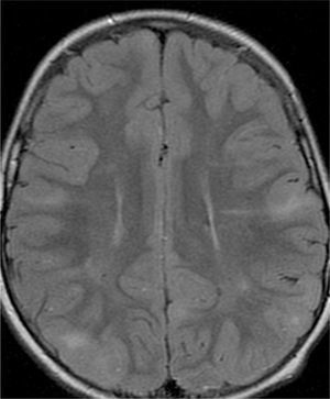 Imagen de resonancia magnética, axial FLAIR, que muestra múltiples áreas de hiperseñal corticosubcorticales (tuberomas) y líneas de migración radial.
