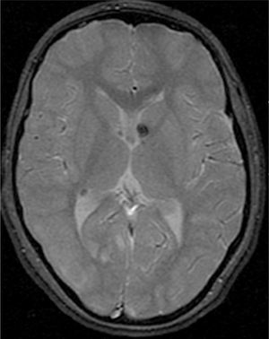 Imagen de resonancia magnética, axial T2*, exhibiendo focos de hiposeñal subependimarios, con proyección hacia el interior de los ventrículos, indicativos de nódulos subependimarios calcificados.