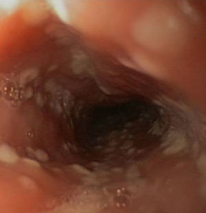Imagen endoscópica del esófago, donde se identifican pequeñas úlceras recubiertas por fibrina de diferente tamaño.