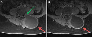 Imágenes de RM, planos axiales. A. Imagen potenciada en T1, con saturación de la grasa; el quiste hidatídico (flecha roja) está situado en el espesor de la musculatura paravertebral lumbar izquierda, es hipointenso y su contenido es homogéneo. Nótese la íntima relación del aspecto más anterior y medial de la lesión con el agujero de conjunción izquierdo de L4-L5 (flecha verde). B. Imagen potenciada en T1, con saturación grasa y obtenida tras la administración de contraste intravenoso, en la que no se observan captaciones de contraste a nivel de la lesión quística (flecha roja).