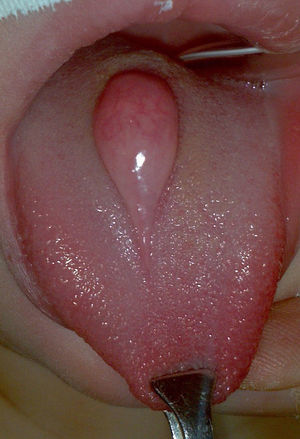Lesión sobreelevada en la línea media de la cara dorsal de la lengua.