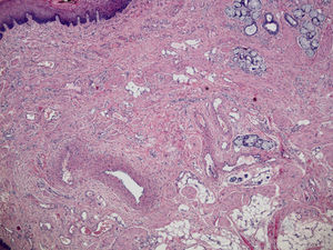 Histopatología. Se observan numerosas estructuras vasculares de pequeño y mediano calibre, de aspecto malformativo, tortuosas, muchas de ellas con válvulas, revestidas por endotelio plano sin atipia.