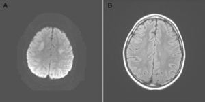 A) Corte axial en secuencia DWI que muestra áreas subcorticales frontales bilaterales que restringen en difusión. B) Corte axial en secuencia FLAIR en el que se observan las mismas áreas subcorticales frontales bilaterales isointensas con el córtex cerebral.