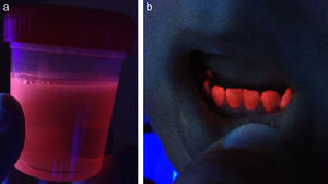 Fluorescencia rojo-rosada emitida bajo la lámpara de Wood por la orina a los 4 meses de edad (a) y los dientes a los 3 años de edad (b).