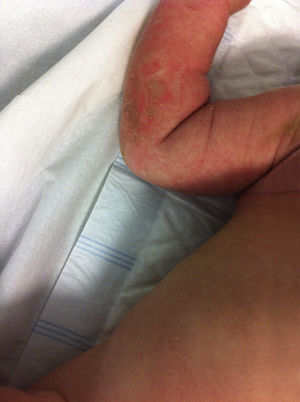 Segundo episodio de escaldadura estafilocócica. Se observan lesiones ampollosas y cambios en piel (escamas hiperqueratósicas).