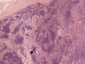 Dilatación sinusoidal (flecha) con histiocitosis, característico de esta enfermedad.