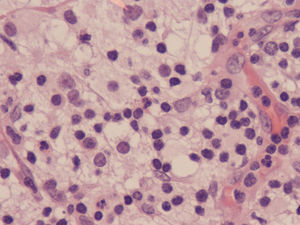 Emperipolesis (linfocitos dentro del citoplasma de los histiocitos).