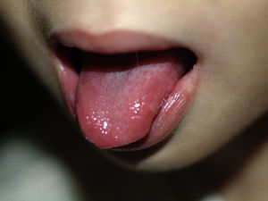 Estomatitis aftosa en mucosa bucal y sobre la lengua. Úlceras redondeadas cubiertas por una seudomembrana blanquecina y con un halo inflamatorio alrededor.