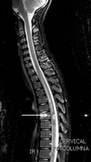 RM medular, corte sagital, secuencia T1: lesión hiperintensa ligeramente expansiva en cordón medular dorsal a la altura de D7, de unos 14×8mm con pequeños flóculos, sugerente de ependimoma.