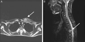 A) RM de clavícula: osteomielitis y absceso subperióstico del extremo proximal de la clavícula izquierda. B) RM de columna: acuñamiento de D6 con edema intraesponjoso, con participación del anillo fibroso del disco intervertebral D5-D6.
